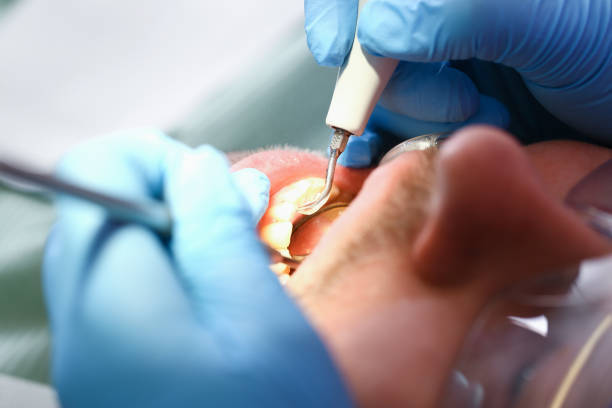 Best Dental Abscess Treatment in Bethesda, MD
