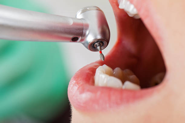 Best Emergency Root Canal Therapy in Bethesda, MD
